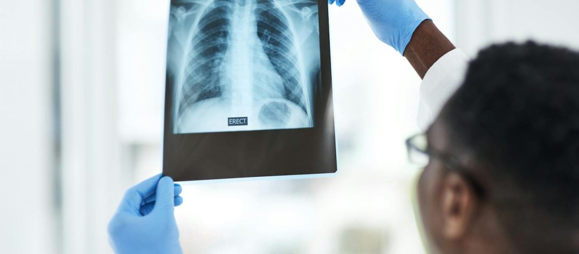 Comment savoir si on a une côte cassée ?